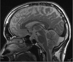 brain MRI
