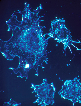 Cancer cells in culture from human connective tissue, illuminated by darkfield amplified contrast, at a magnification of 500x. (National Cancer Institute)